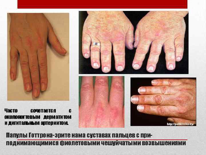 Часто сочетается с околоногтевым дерматитом и дигитальным артериитом. Папулы Готтрона-эрите нама суставах пальцев с