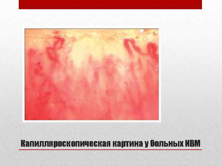 Капилляроскопическая картина у больных ИВМ 