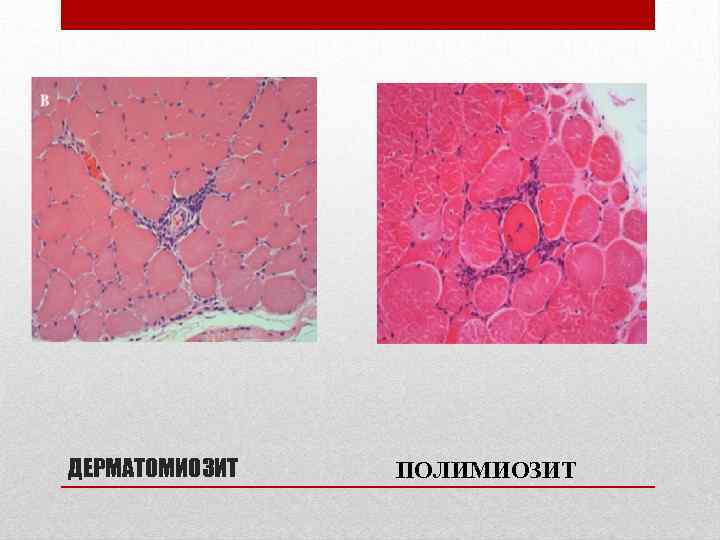 ДЕРМАТОМИОЗИТ ПОЛИМИОЗИТ 