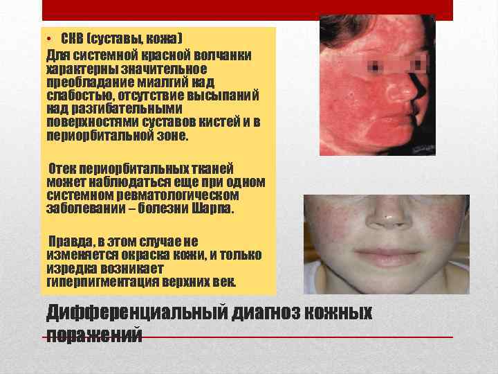 • СКВ (суставы, кожа) Для системной красной волчанки характерны значительное преобладание миалгий над
