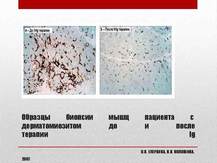 Образцы биопсии дерматомиозитом терапии мышц до пациента с и после Ig О. В. ЕГОРКИНА,