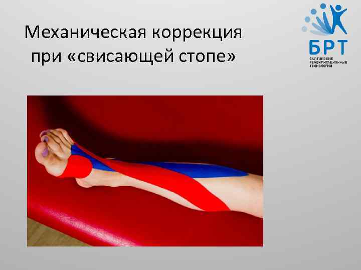 Механическая коррекция при «свисающей стопе» 