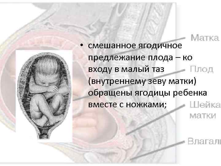  • смешанное ягодичное предлежание плода – ко входу в малый таз (внутреннему зеву