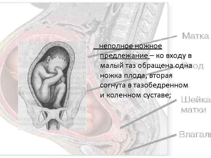  неполное ножное предлежание – ко входу в малый таз обращена одна ножка плода,