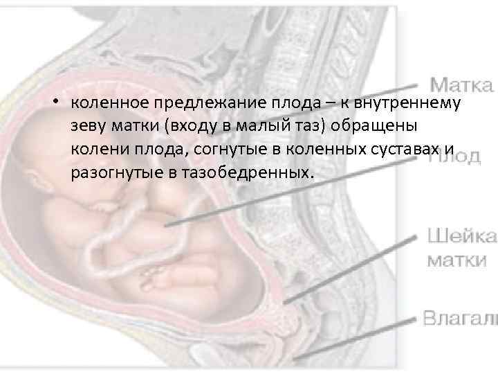  • коленное предлежание плода – к внутреннему зеву матки (входу в малый таз)