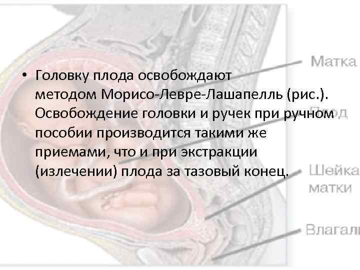  • Головку плода освобождают методом Морисо-Левре-Лашапелль (рис. ). Освобождение головки и ручек при