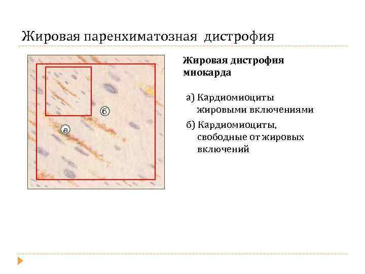 Жировая паренхиматозная дистрофия Жировая дистрофия миокарда б а а) Кардиомиоциты жировыми включениями б) Кардиомиоциты,