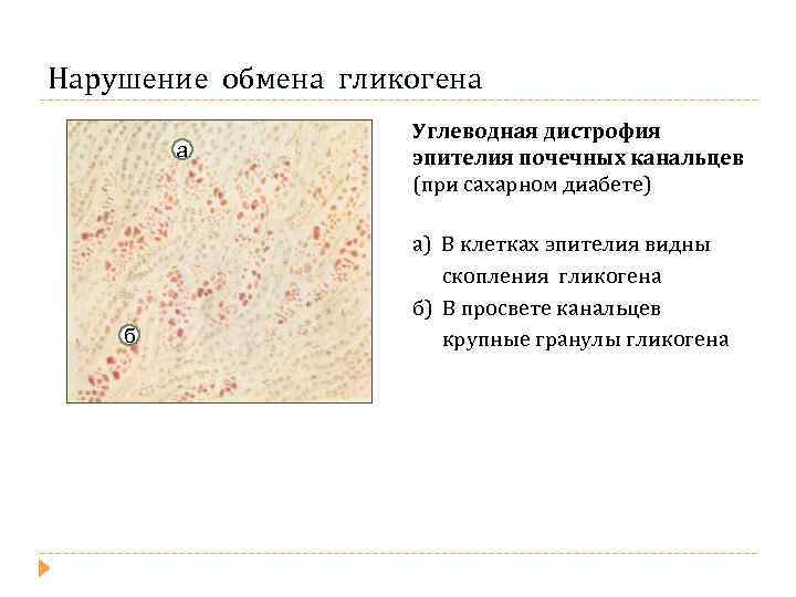 Нарушение обмена гликогена а б Углеводная дистрофия эпителия почечных канальцев (при сахарном диабете) а)