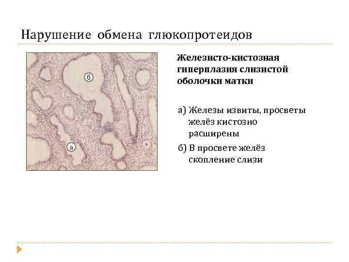 Нарушение обмена глюкопротеидов б а Железисто-кистозная гиперплазия слизистой оболочки матки а) Железы извиты, просветы