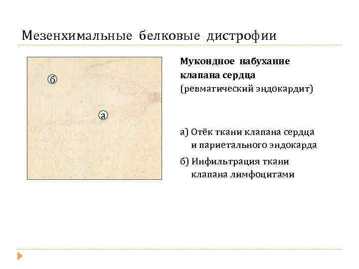 Мезенхимальные белковые дистрофии Мукоидное набухание клапана сердца (ревматический эндокардит) б а а) Отёк ткани