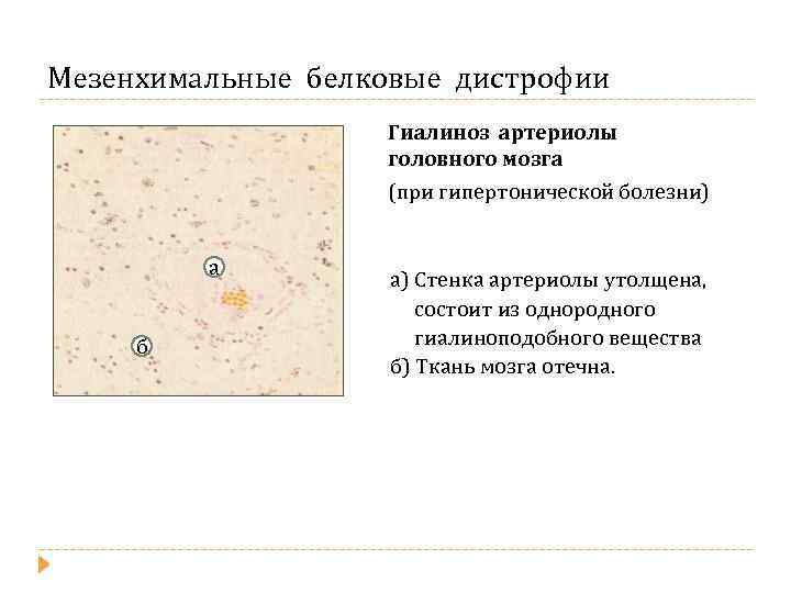 Мезенхимальные белковые дистрофии Гиалиноз артериолы головного мозга (при гипертонической болезни) а б а) Стенка