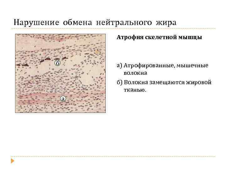 Нарушение обмена нейтрального жира Атрофия скелетной мышцы б а) Атрофированные, мышечные волокна б) Волокна