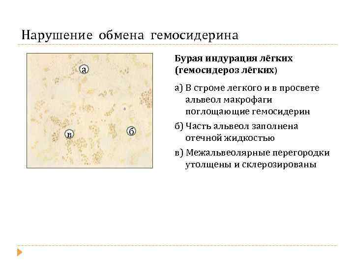 Нарушение обмена гемосидерина Бурая индурация лёгких (гемосидероз лёгких) а в б а) В строме