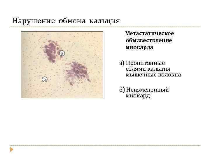 Нарушение обмена кальция Метастатическое обызвествление миокарда а б а) Пропитанные солями кальция мышечные волокна