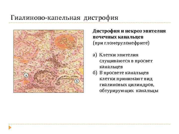 Гиалиново-капельная дистрофия Дистрофия и некроз эпителия почечных канальцев (при гломерулонефрите) а б а) Клетки