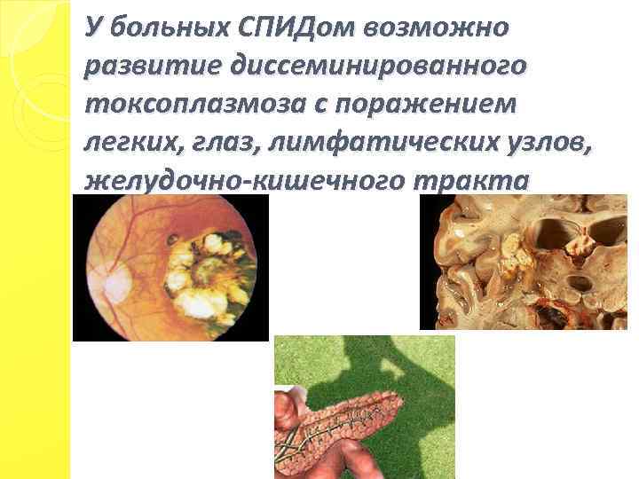 У больных СПИДом возможно развитие диссеминированного токсоплазмоза с поражением легких, глаз, лимфатических узлов, желудочно-кишечного