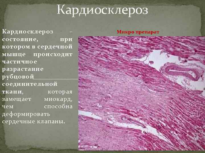 Кардиосклероз – состояние, при котором в сердечной мышце происходит частичное разрастание рубцовой соединительной ткани,