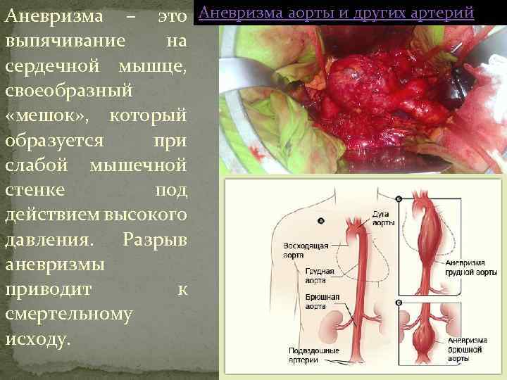 Аневризма – это Аневризма аорты и других артерий выпячивание на сердечной мышце, своеобразный «мешок»