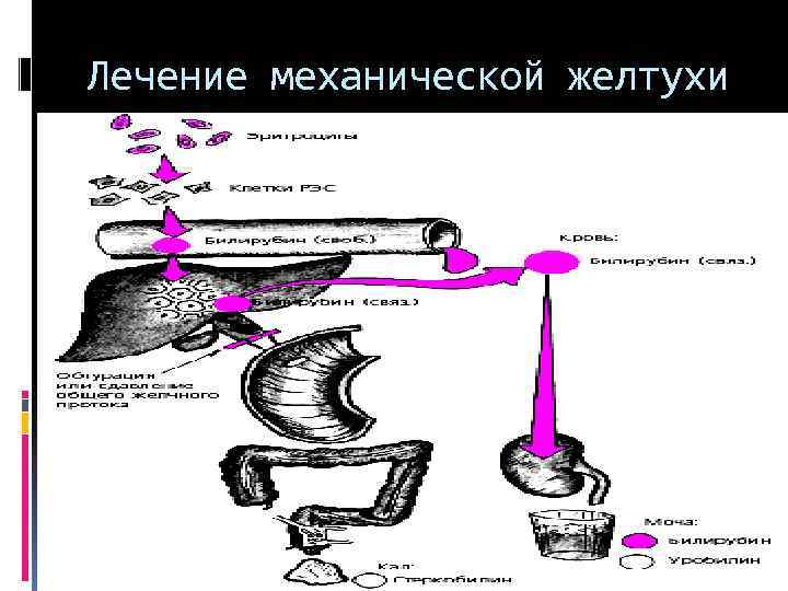 Механическая желтуха при раке. Терапия механической желтухи. Методы диагностики механической желтухи.