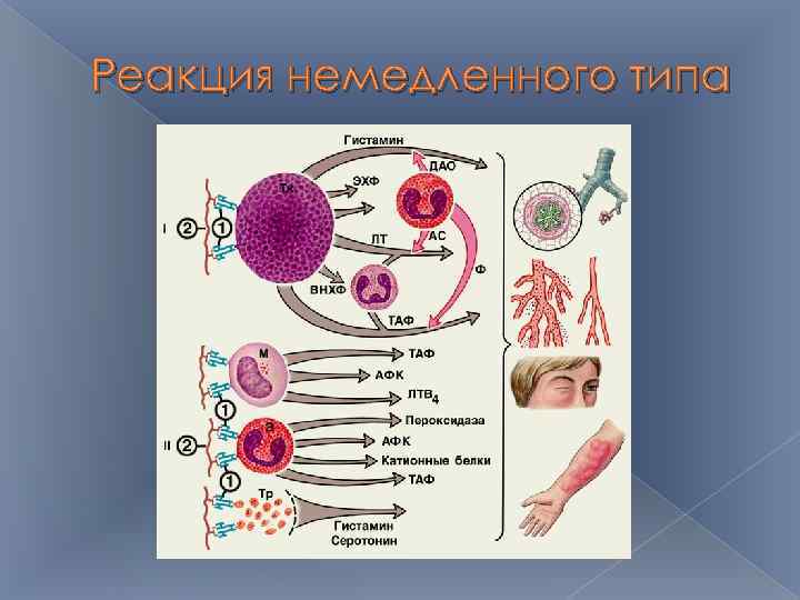 Реакция немедленного типа 