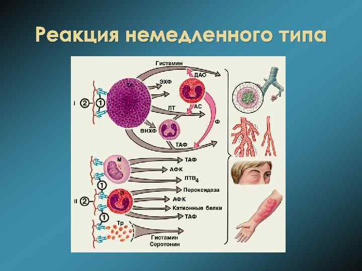 Реакция немедленного типа 