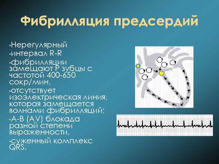 Фибрилляция предсердий • Нерегулярный • интервал R-R • фибрилляции замещают Р зубцы с частотой