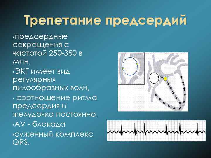 Трепетание предсердий • предсердные сокращения с частотой 250 -350 в мин, • ЭКГ имеет