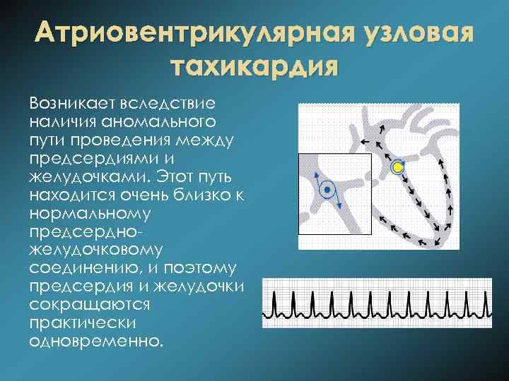 Атриовентрикулярная узловая тахикардия Возникает вследствие наличия аномального пути проведения между предсердиями и желудочками. Этот