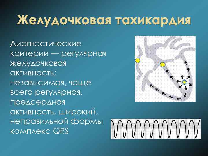 Желудочковая тахикардия Диагностические критерии — регулярная желудочковая активность; независимая, чаще всего регулярная, предсердная активность,