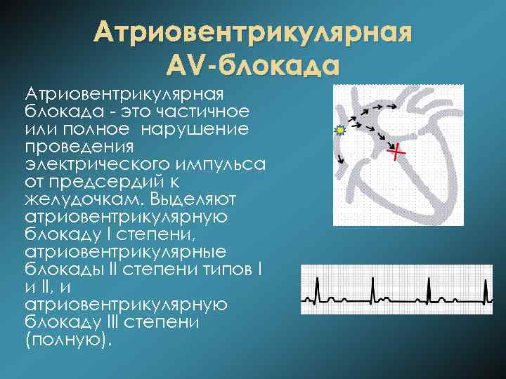 Атриовентрикулярная AV-блокада Атриовентрикулярная блокада - это частичное или полное нарушение проведения электрического импульса от