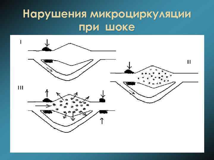 Нарушения микроциркуляции при шоке 