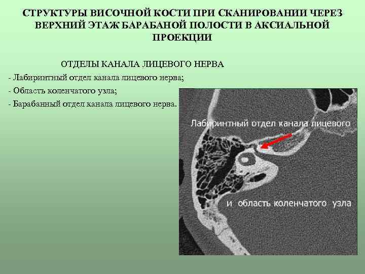 СТРУКТУРЫ ВИСОЧНОЙ КОСТИ ПРИ СКАНИРОВАНИИ ЧЕРЕЗ ВЕРХНИЙ ЭТАЖ БАРАБАНОЙ ПОЛОСТИ В АКСИАЛЬНОЙ ПРОЕКЦИИ ОТДЕЛЫ