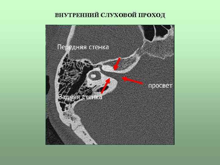 ВНУТРЕННИЙ СЛУХОВОЙ ПРОХОД 