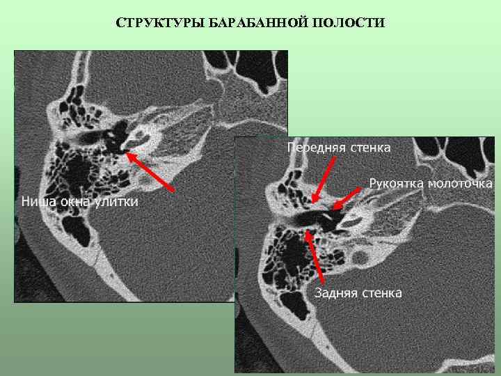 СТРУКТУРЫ БАРАБАННОЙ ПОЛОСТИ 