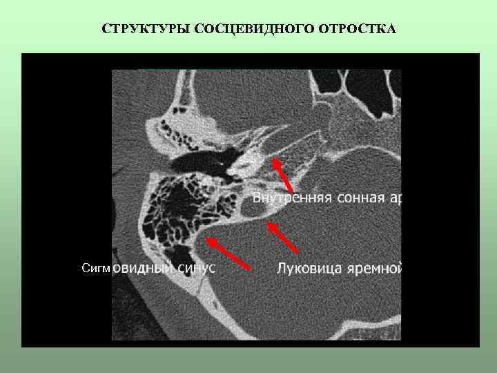 СТРУКТУРЫ СОСЦЕВИДНОГО ОТРОСТКА Сигм 