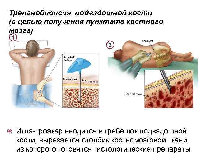 Трепанобиопсия подвздошной кости (с целью получения пунктата костного мозга) 1 2 Игла-троакар вводится в