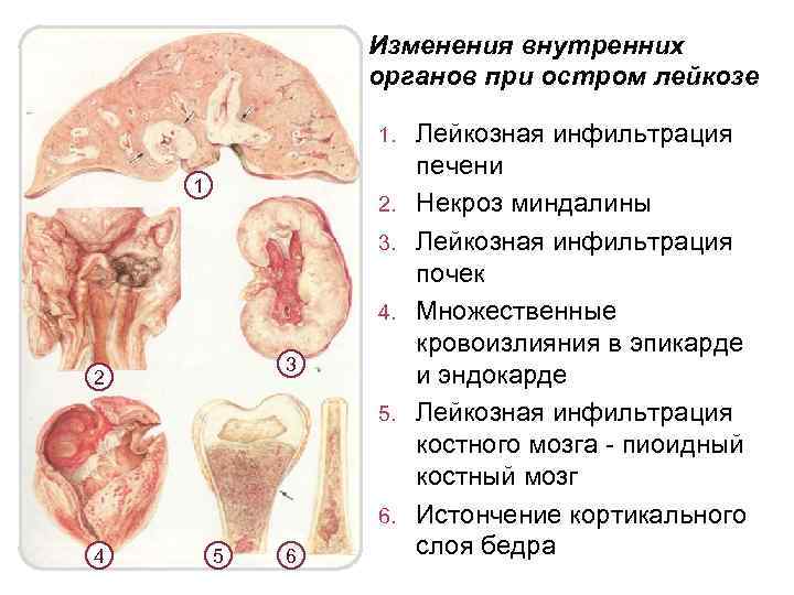 Изменения внутренних органов при остром лейкозе 1. 1 2. 3. 4. 3 2 5.