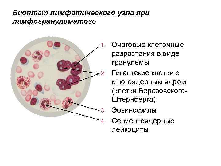 Биоптат лимфатического узла при лимфогранулематозе Очаговые клеточные разрастания в виде гранулёмы 2. Гигантские клетки