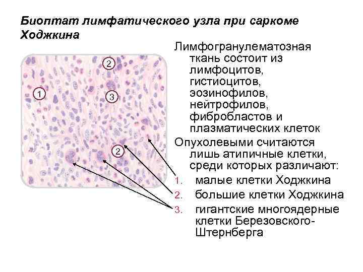 Биоптат лимфатического узла при саркоме Ходжкина Лимфогранулематозная ткань состоит из 2 лимфоцитов, гистиоцитов, эозинофилов,