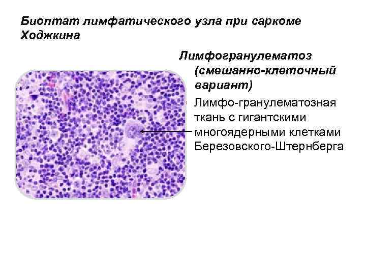 Биоптат лимфатического узла при саркоме Ходжкина Лимфогранулематоз (смешанно-клеточный вариант) Лимфо-гранулематозная ткань с гигантскими многоядерными