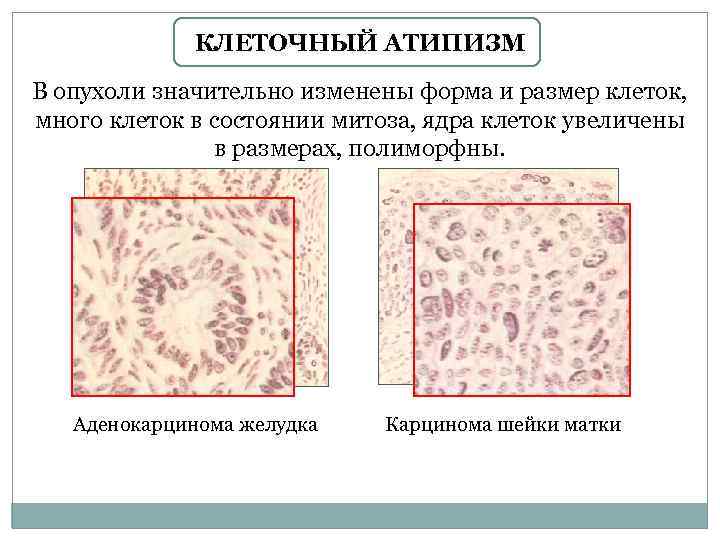 КЛЕТОЧНЫЙ АТИПИЗМ В опухоли значительно изменены форма и размер клеток, много клеток в состоянии