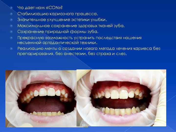  Что дает нам «ICON» ? Cтабилизацию кариозного процесса. Значительное улучшение эстетики улыбки. Максимальное