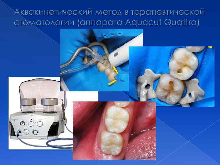 Аквакинетический метод в терапевтической стоматологии (аппарата Aquacut Quattro) 
