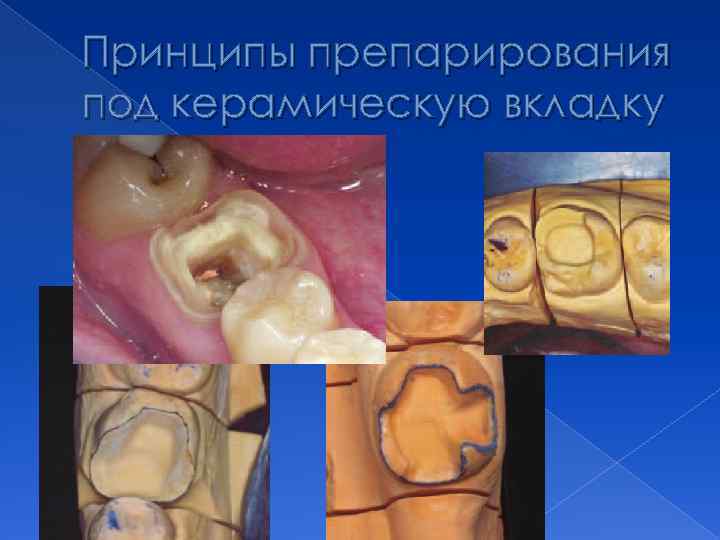 Принципы препарирования под керамическую вкладку 