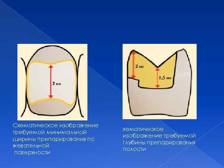 Схематическое изображение требуемой минимальной ширины препарирования по жевательной поверхности хематическое изображение требуемой глубины препарирования