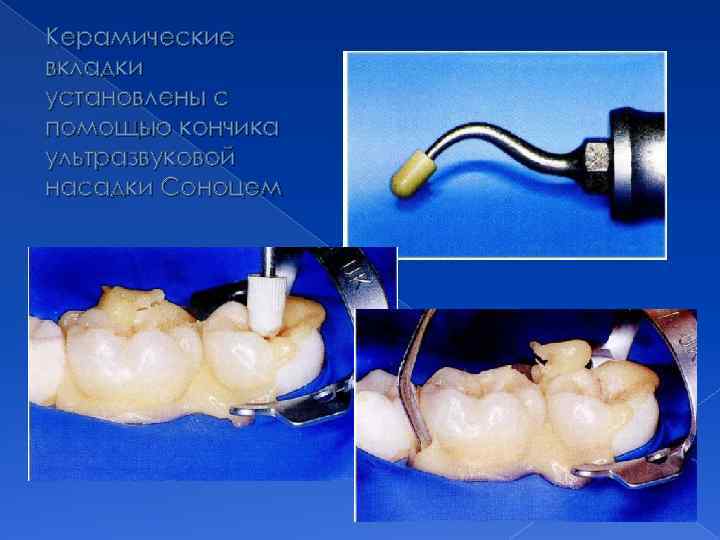Керамические вкладки установлены с помощью кончика ультразвуковой насадки Соноцем 