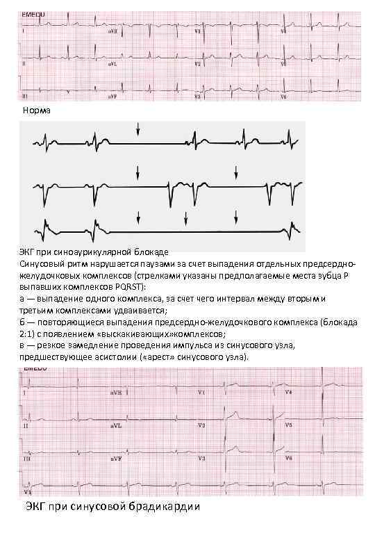 Норма ЭКГ при синоаурикулярной блокаде Синусовый ритм нарушается паузами за счет выпадения отдельных предсердножелудочковых