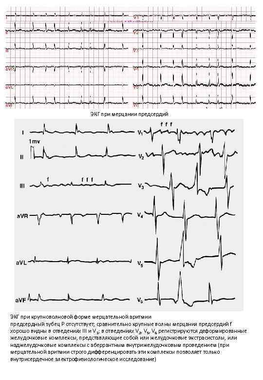 ЭКГ при мерцании предсердий ЭКГ при крупноволновой форме мерцательной аритмии предсердный зубец Р отсутствует;