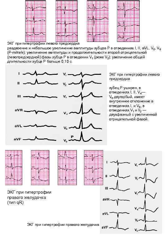 ЭКГ при гипертрофии левого предсердия раздвоение и небольшое увеличение амплитуды зубцов Р в отведениях