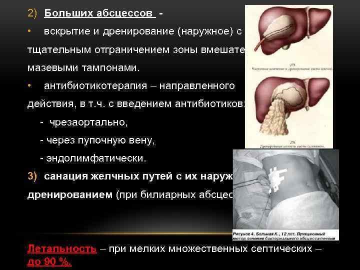 2) Больших абсцессов • вскрытие и дренирование (наружное) с тщательным отграничением зоны вмешательства мазевыми